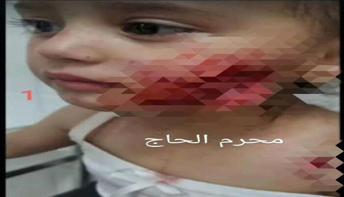 حادثة مروعة في تعز | غضب عارم بعد نهش كلب مسعور وجه طفلة في الروضة